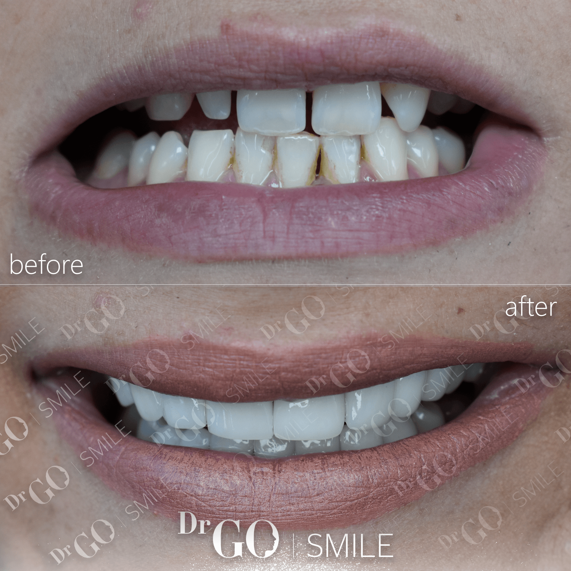 Лечение отбеливания зубов Стоматолог Турция - DRGO Smile Clinic