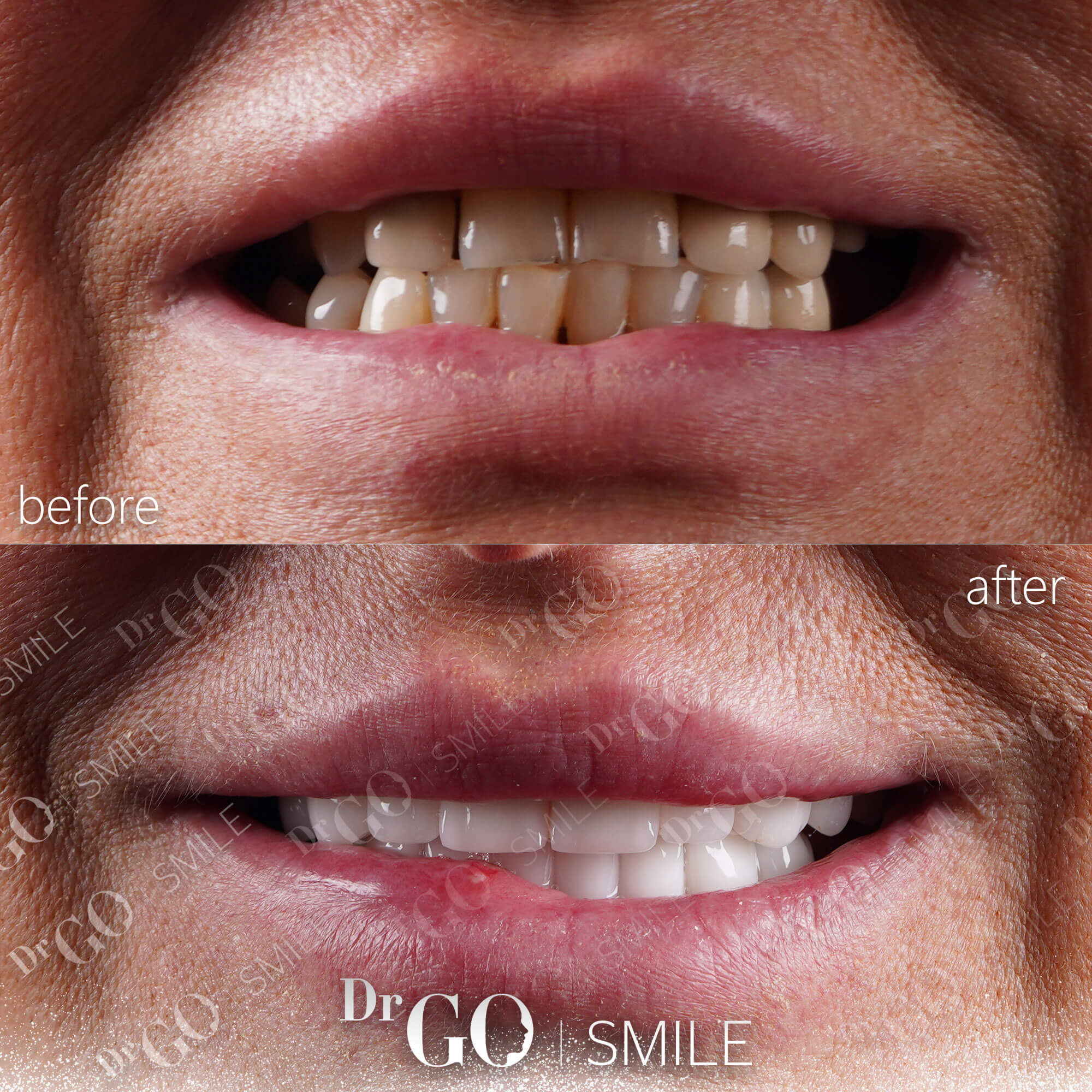 Лечение отбеливания зубов Стоматолог Турция - DRGO Smile Clinic